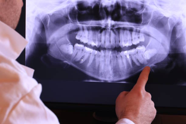 Best Emergency Tooth Extraction in Keary, NE